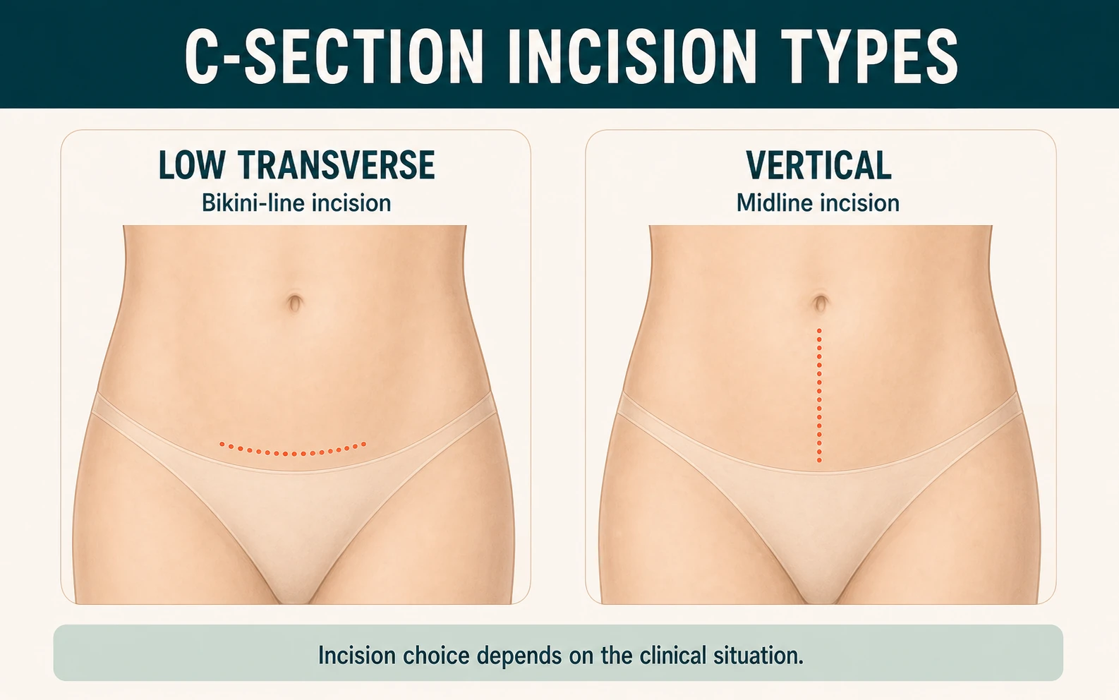 Schematic comparison of low transverse and vertical C-section skin incision placement